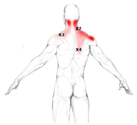 Muscle trapèze : douleurs et trigger points